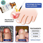 OFERTA 2X1 🍃 Tratamiento SIN DOLOR! Antihongos para Uñas- Nail Fungus Essence   🍃