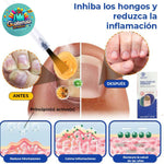 OFERTA 2X1 🍃 Tratamiento SIN DOLOR! Antihongos para Uñas- Nail Fungus Essence   🍃